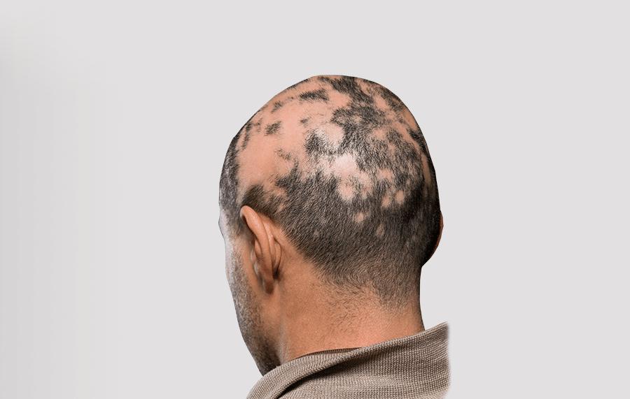 Alopecia behandeling