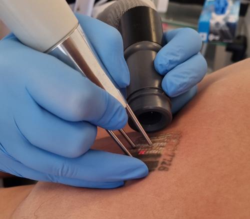 Behandeling tatoeage verwijderen