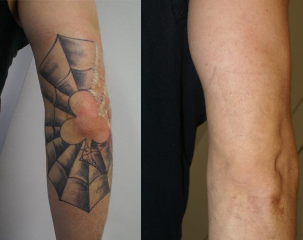 tattoo removal rotterdam