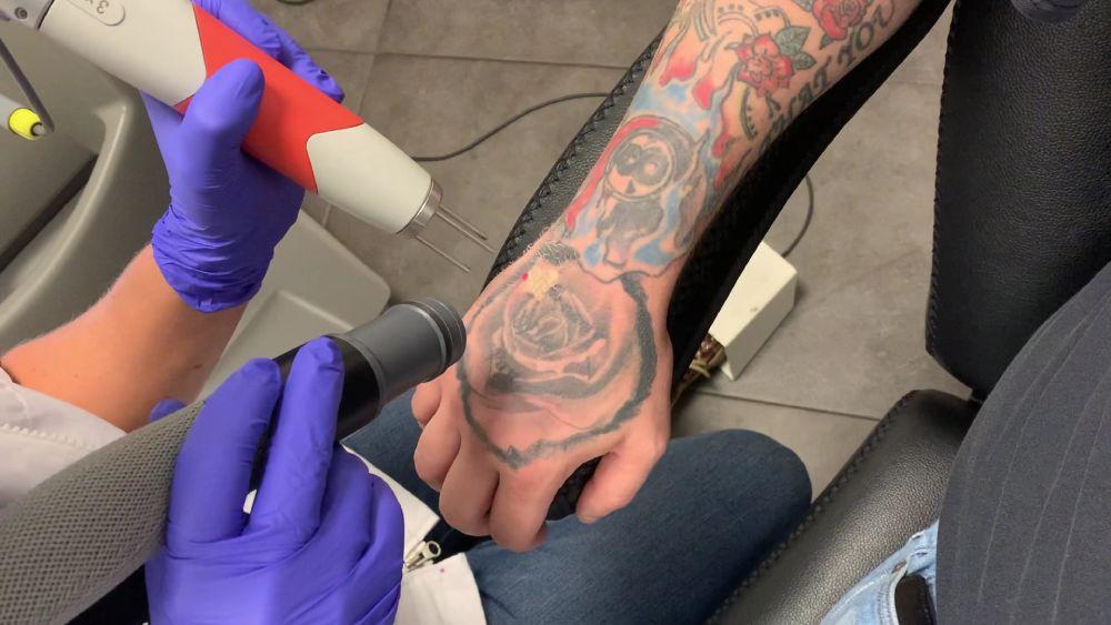 Tattoo verwijdering Rotterdam