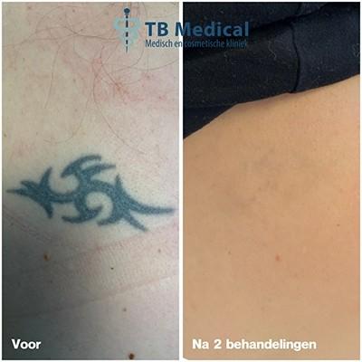 spijt van je tattoo