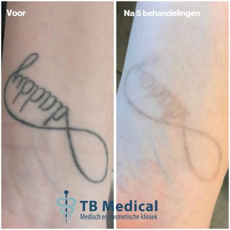 Nieuwe trend Tattoo verwijdering